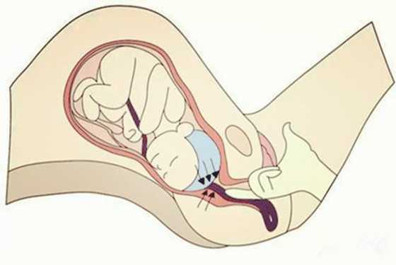 广州供卵自怀，胎盘低置能顺产？胎盘低置几个月最危险