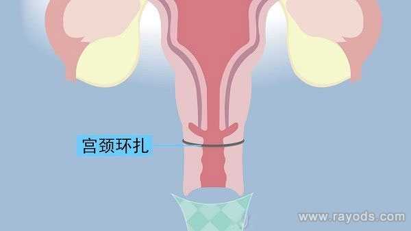 广州有名供卵试管，什么是宫颈环扎,宫颈环扎术最佳时间