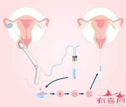 广州试管代生筛查,广州试管婴儿可以基因筛查优生优育吗？